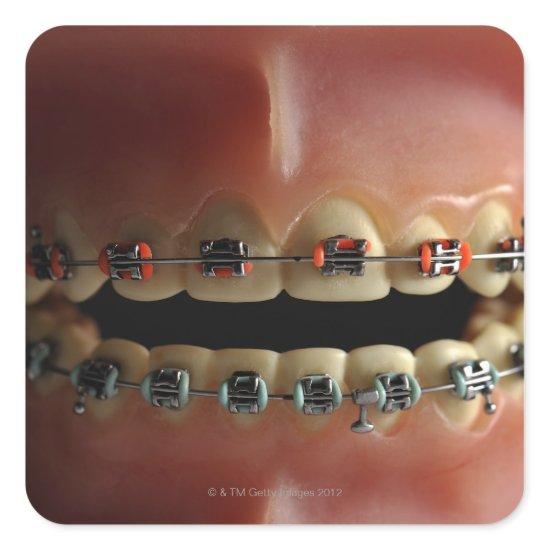 A dental model and Teeth braces Square Sticker