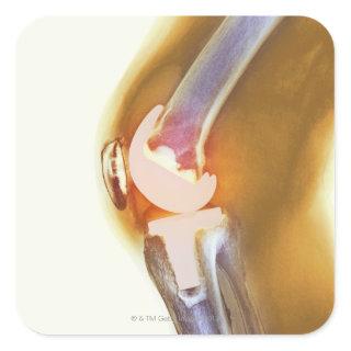 Knee replacement. Coloured X-ray of a total knee Square Sticker